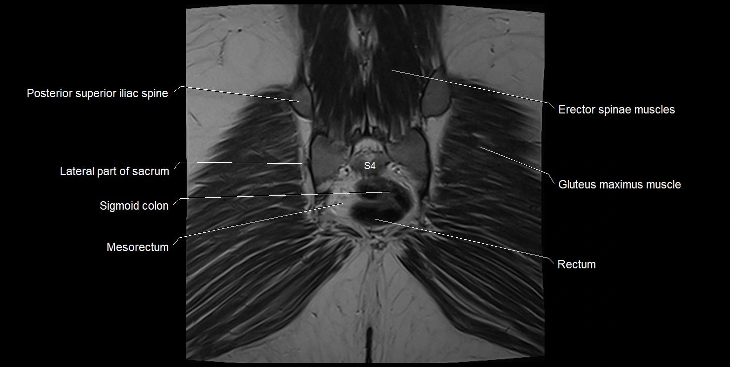 female pelvis coronal cross sectional anatomy image 34.webp